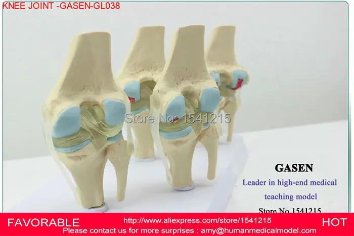 Модель коленного сустава модель человеческого скелета артропатия патология