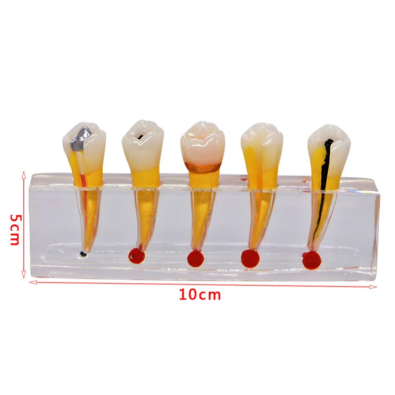 Dental Pulp Restoration Pathological Model with Detachable teeth Premolar caries crown pulp cavity filling | Красота и здоровье