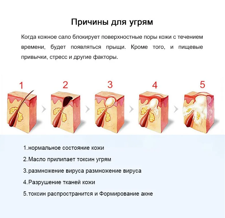 Крем для лечения прыщей с экстрактом китайской травы Анти-Акне Крем с Китайской травяной Экстракт лечение прыщ для прыщей прыщи угри выдавливать угри от прыщей Акне прыщ шрамов от угревой сыпи и Жирной кожи для прыщей