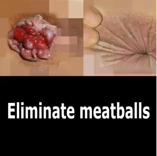 Геморрой мазь суппозиторий мощный геморрой внешние геморроя анальная трещина