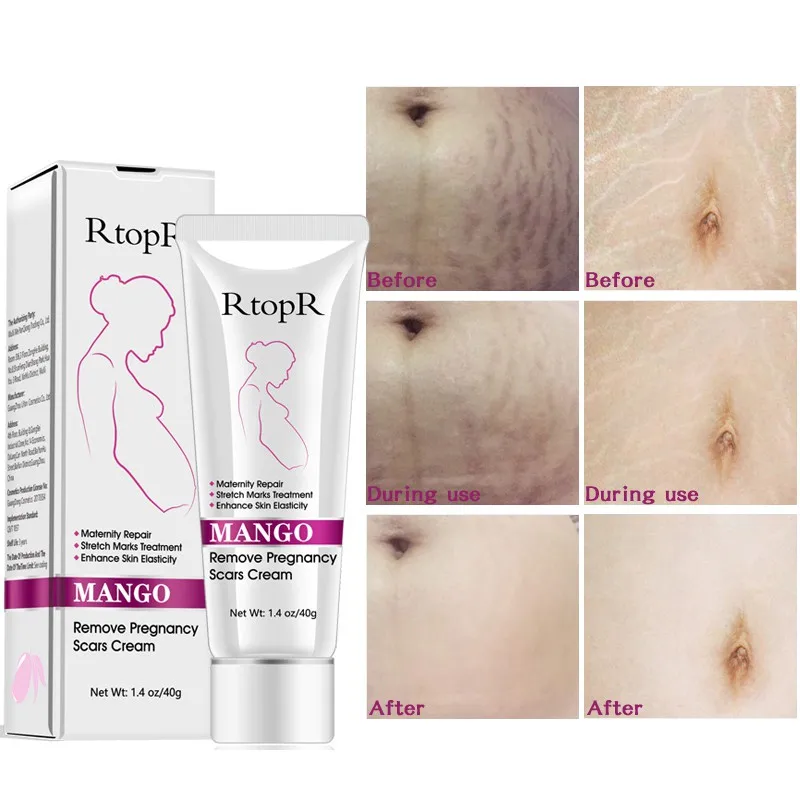 2019 new! Natural Mild Non-irritating Mango Stretch Mark Cream For Pregnancy Repair Scar Slack Line Abdomen Marks | Красота и