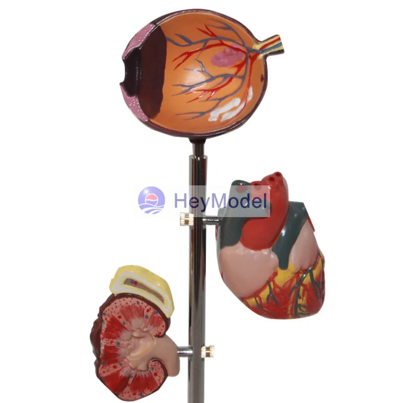 HeyModel человеческий диабет модель очага повреждений|Образовательное