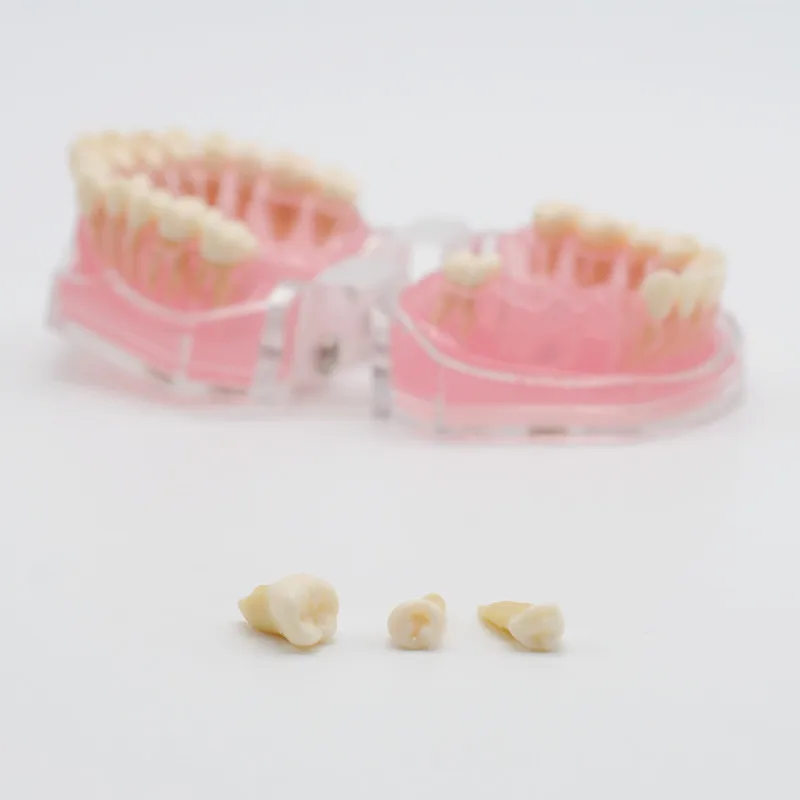 Стоматология лабораторная модель исследования зубов Overdenture Нижняя 4 имплантата