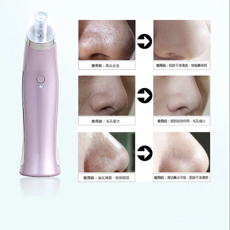 Acne Уход за кожей лица пылесос Черноголовых пятновыводитель машины пор Прыщ Extractor