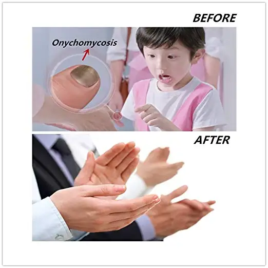 lllt light laser therapy device Onychomycosis Treatment Instrument for toe nails finger fungus remove rechargeable |