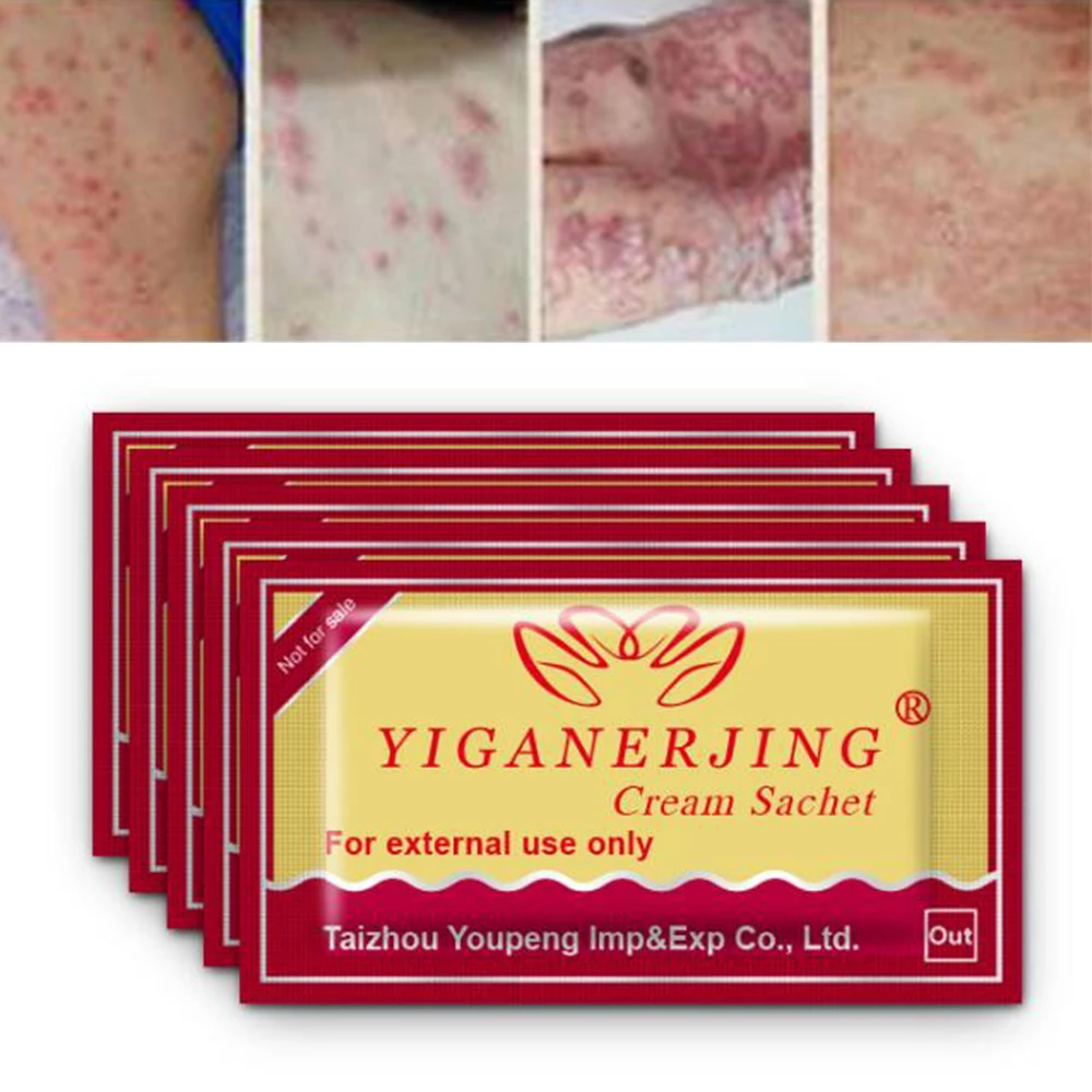 Body Psoriasis Cream Dermatitis and Eczema Pruritus Ointment 1 Piece D363 | Красота и здоровье