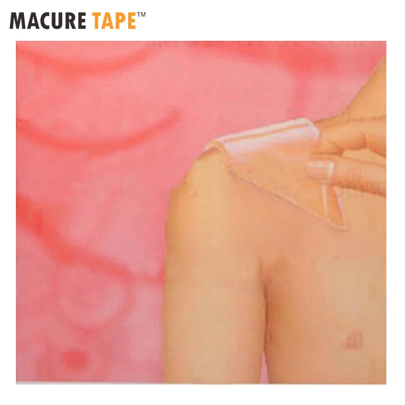 

12CM*8CM Patches Silicone Gel Scar Away Therapy Wound Scar Paste Removel Cesarean Section Hypertrophic Keloid Scar Removal