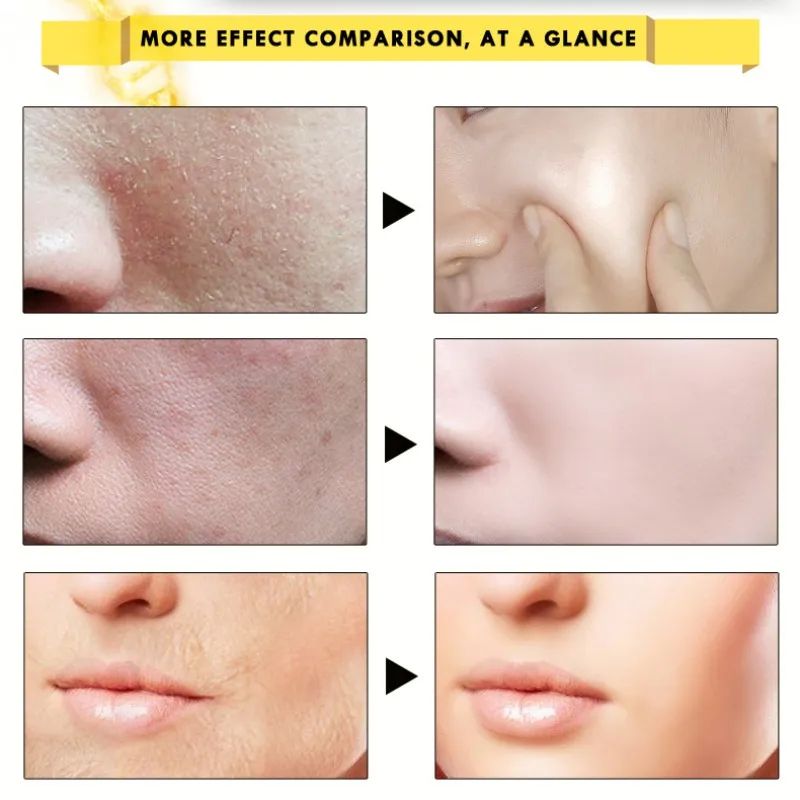 5 шт. увлажняющая питательная сыворотка с гиалуроновой кислотой|Сыворотка| |