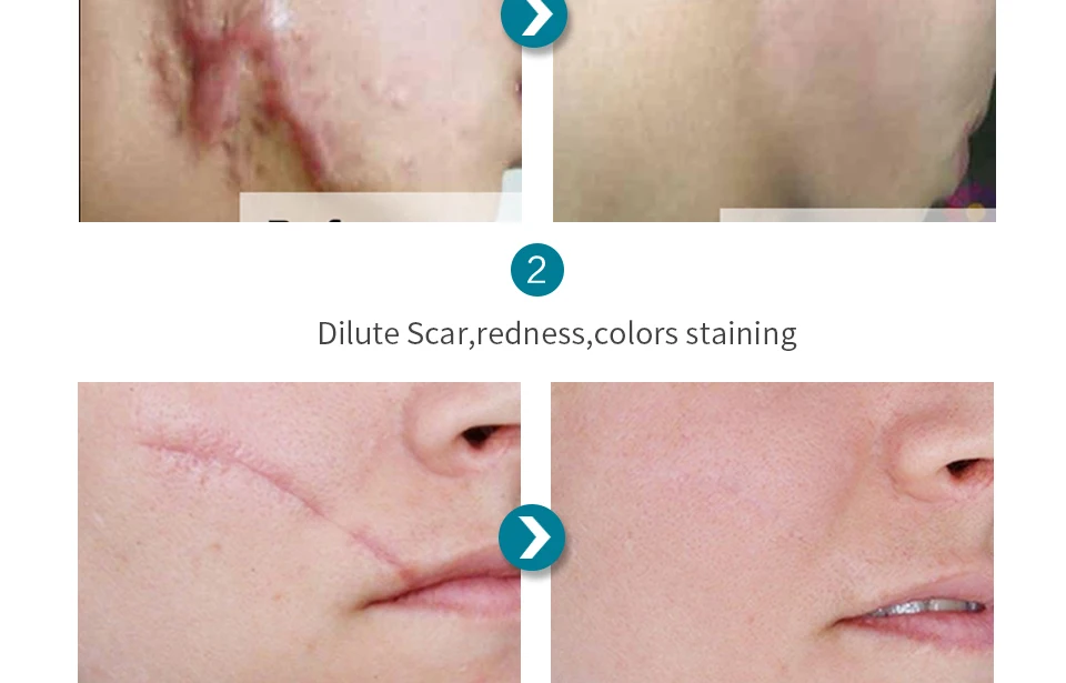 HEMEIEL парк Спрингс аккор, креп от шрамов и анти-акне уменьшить покраснение Ремонт по уходу за кожей лечение корейский уход за кожей лица отбеливающий увлажняющий крем 30 мл