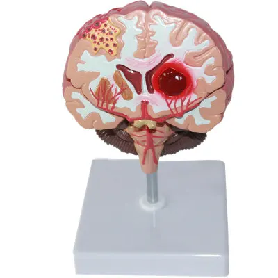 Human brain model Brain pathology free shipping