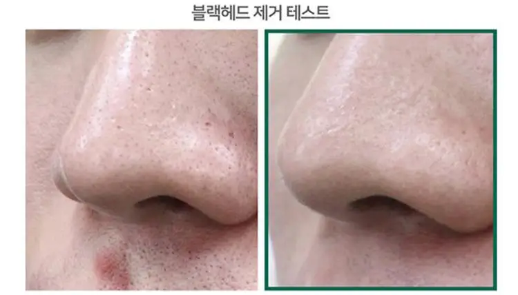 SOME BY MI AHA BHA PHA 30 Days Miracle Starer Kit Edition Сыворотка для лица лечение акне крем для удаления черных точек кожного сала тонер