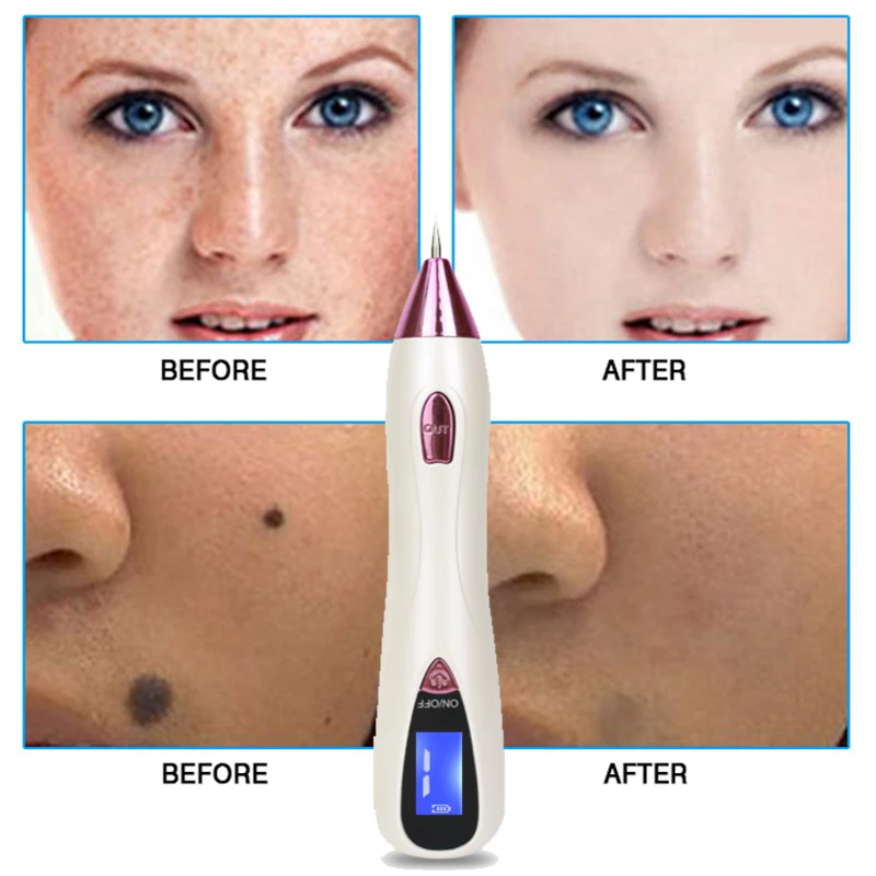 Инструмент для ухода за кожей лазерная плазменная ручка удаления родинок
