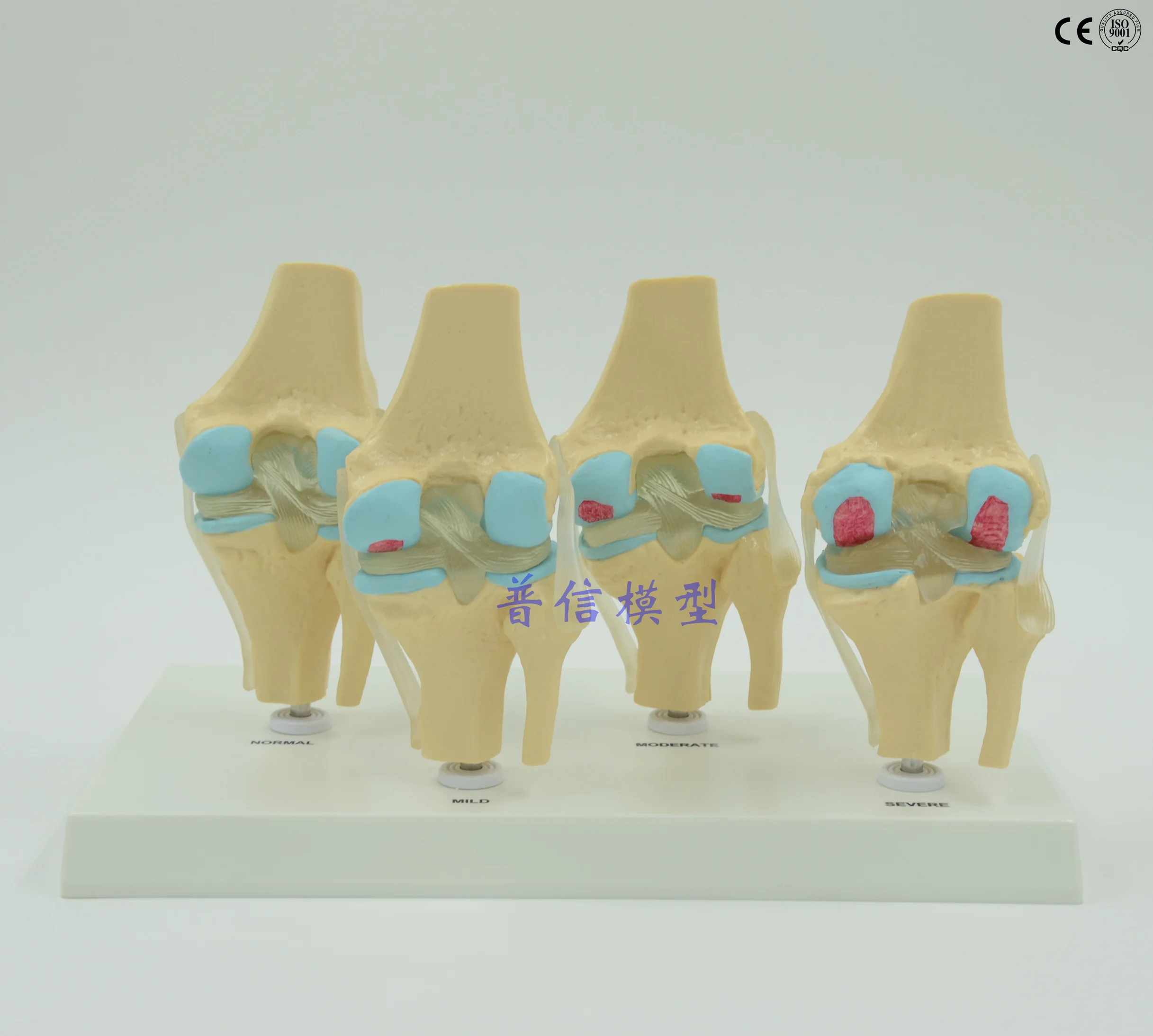 

Free shipping&Human knee joint disease model, bone tissue, four stage knee joint model. Department of orthopedics model medical.