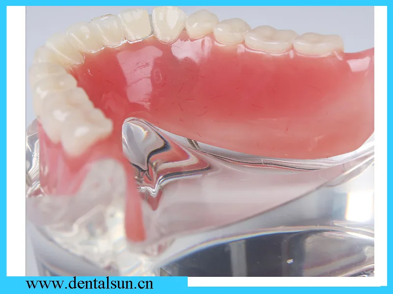 Приспособления для зубных имплантатов и мостовой абутмент зубов/протезная