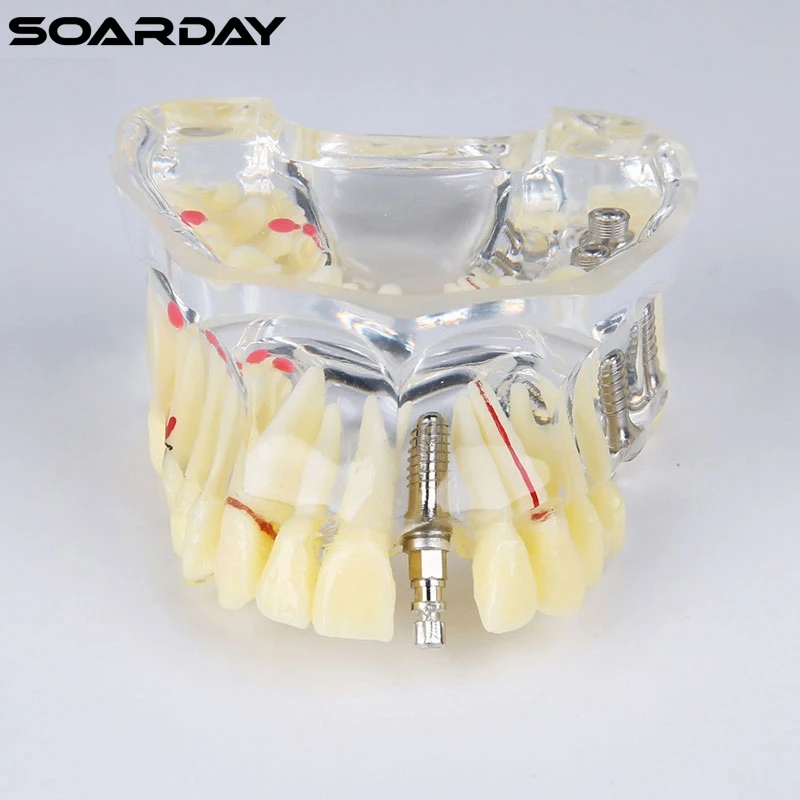 Модель имплантата с мостиком и кариесом для стоматологической связи зубные зубы