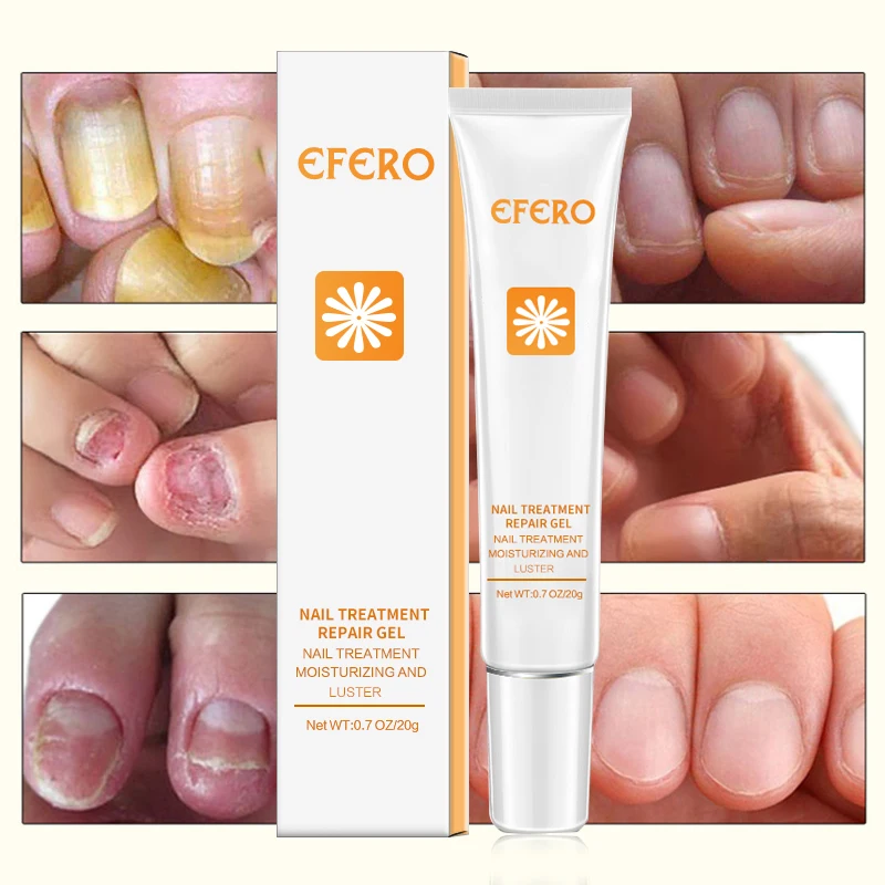 EFERO грибковый Уход за ногтями, эссенция для ухода за ногами, удаление грибка для ног, анти-инфекция, онихомикоз, ремонт ногтей, эссенция, крем