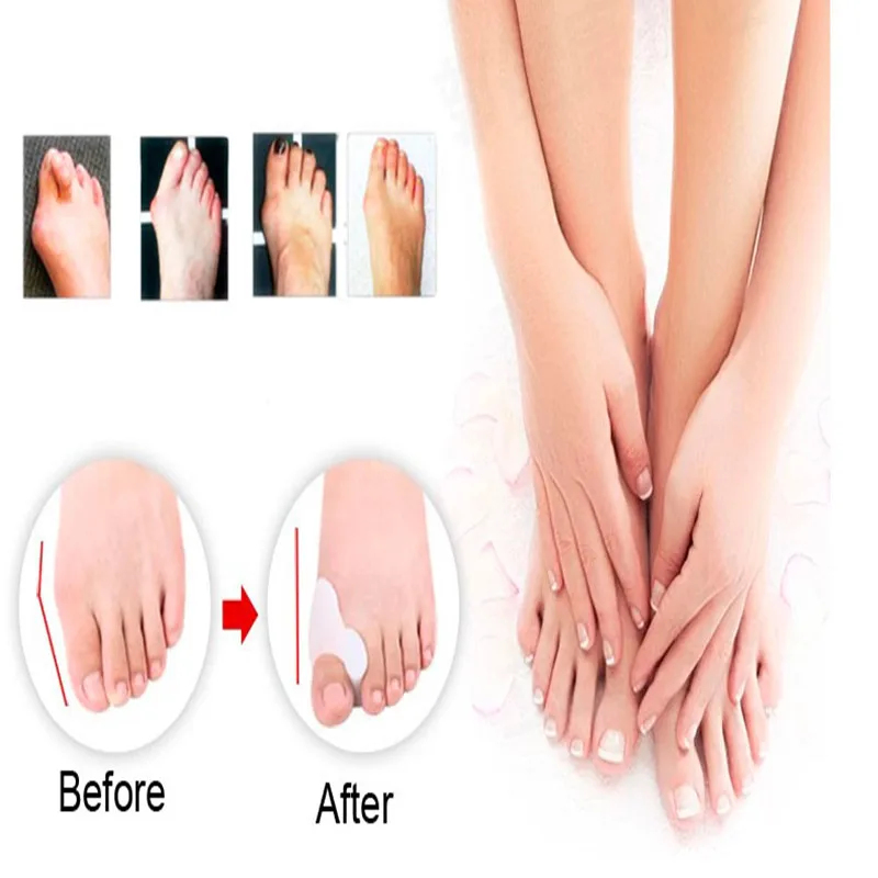 2 шт./пара силиконовые гелевые сепараторы для пальцев ног ортопедическая