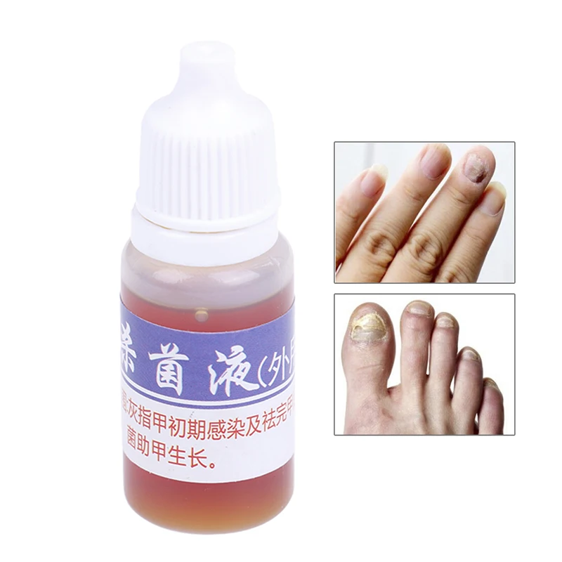 

Useful Fungal Nail Treatment Feet Care Essence Foot Whitening Toenail Fungus Removal Anti Infection Paronychia Onychomycosis