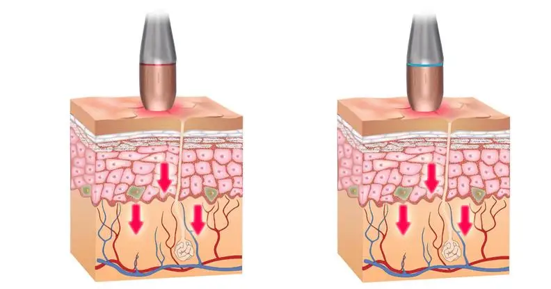 Аппарат Ультразвуковой для подтяжки и лифтинга кожи лица с радаром|Устройства