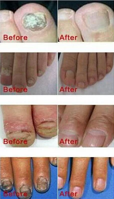 Грибковые Ногтей Лечение TCM Сущность Масло Руки и Ноги Отбеливающий Грибок Ногтя