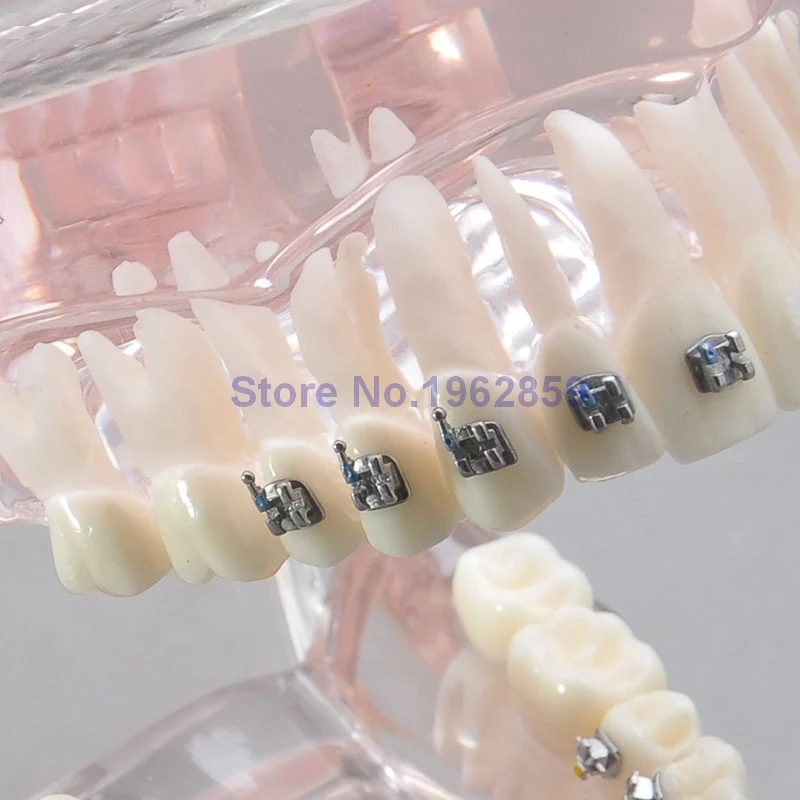 

Teeth Model Orthodontic 4-type Brackets Contrast Metal Ceramic Lingual Invisalign Braces Dental Orthodontic Model
