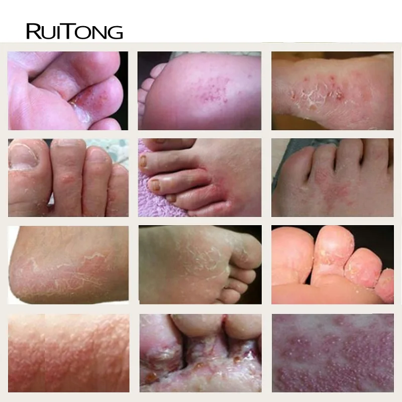 Крем мазь RUITONG 12 шт. 29A натуральный псориаси экзма идеально подходит для всех