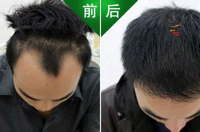 2 шт. продукты для выпадения волос натуральные без побочных эффектов роста более