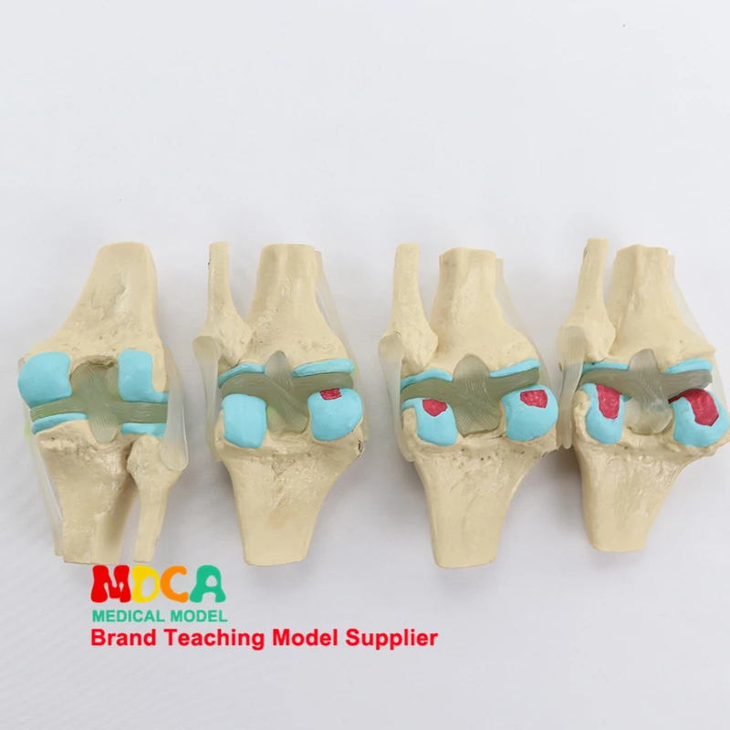 

Four type knee joint normal knee bone disease combined model skeleton model Department of orthopedics medical teaching MGJ007