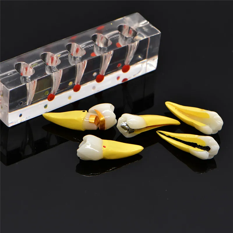 Dental Pulp Restoration Pathological Model with Detachable teeth Premolar caries crown pulp cavity filling | Красота и здоровье