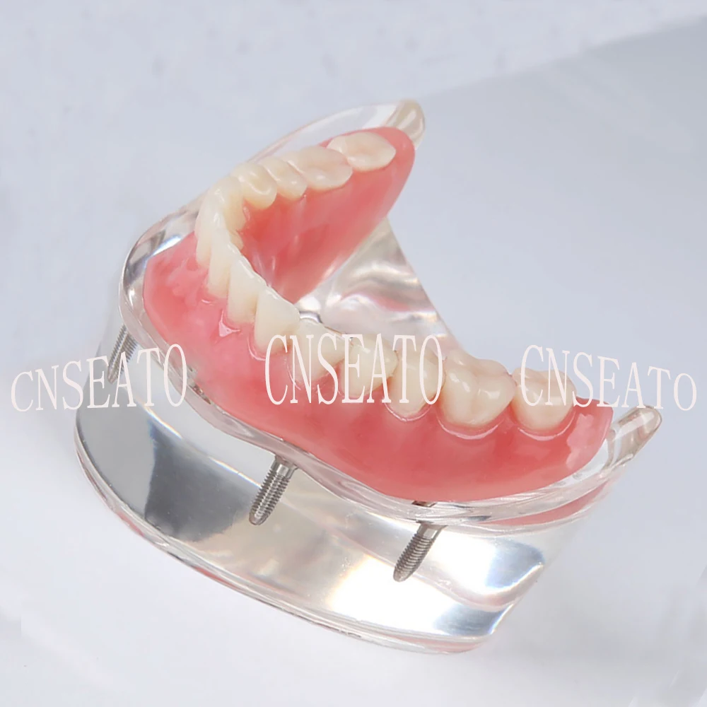 1 шт. стоматологический имплантат восстановление демонстрационная модель зубов M