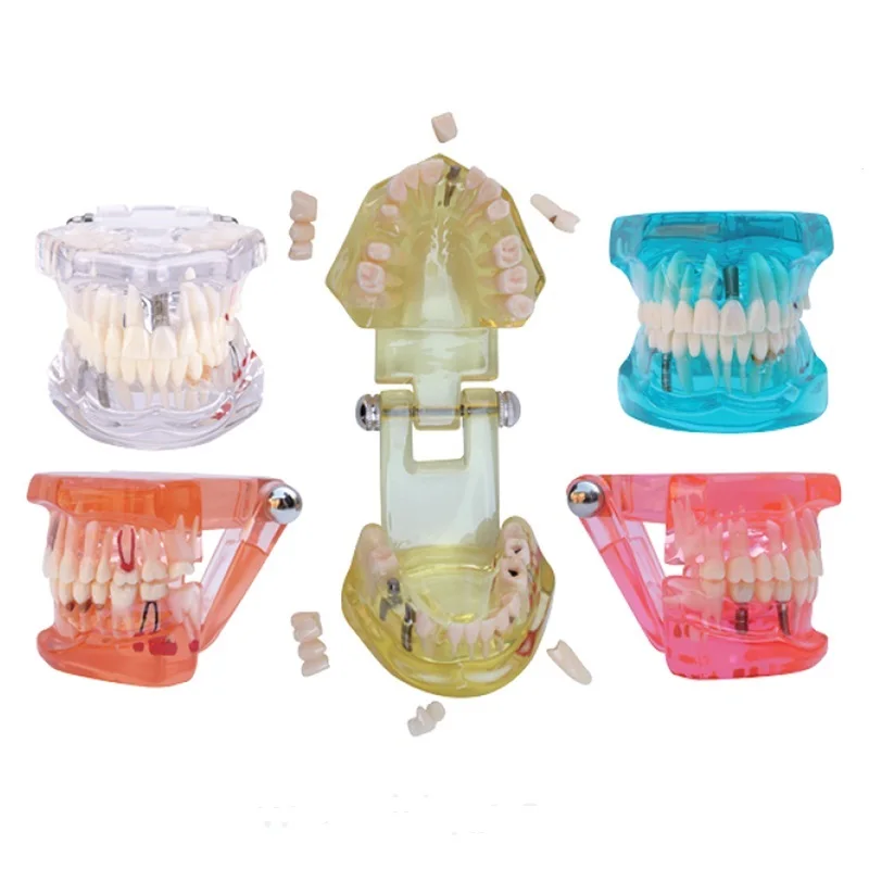 

C15 Dental Implant Disease Teeth Human Medical Orthodontic Model Dental Implant Teeth Model with Restoration and Pathologies