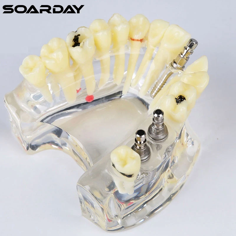 Модель имплантата с мостиком и кариесом для стоматологической связи зубные зубы