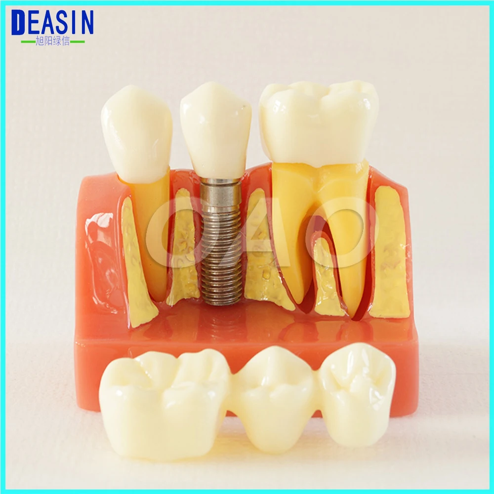 

DENTOFORM MACRO IMPLANT CROWN BRIDGE DEMOSTRATATION TEETH TOOH TYPODONT TEETH MODEL