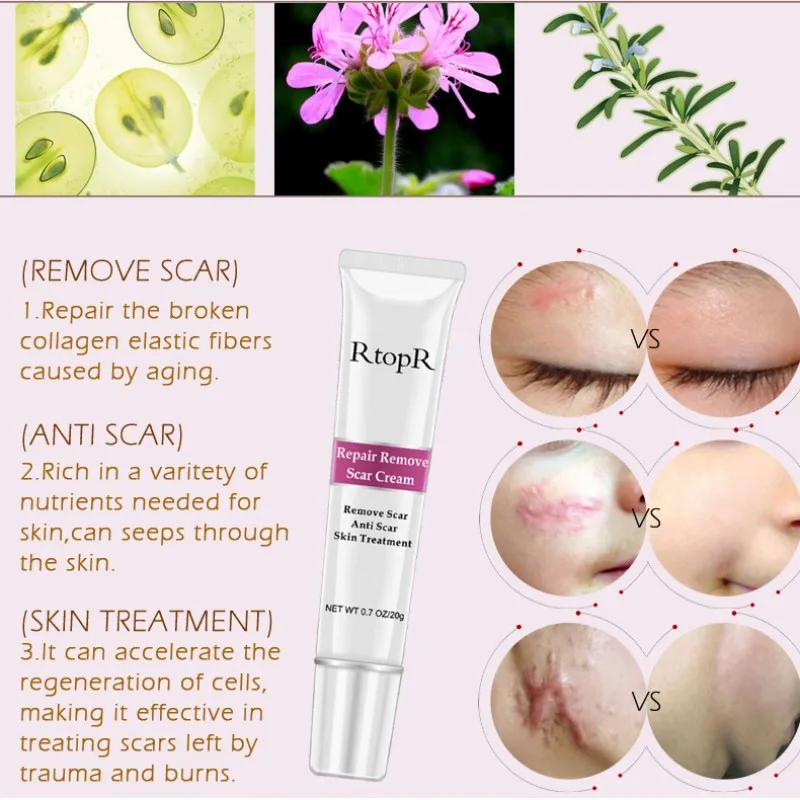 2019 восстановление лица крем для лечения акне угрей черных точек отбеливающий