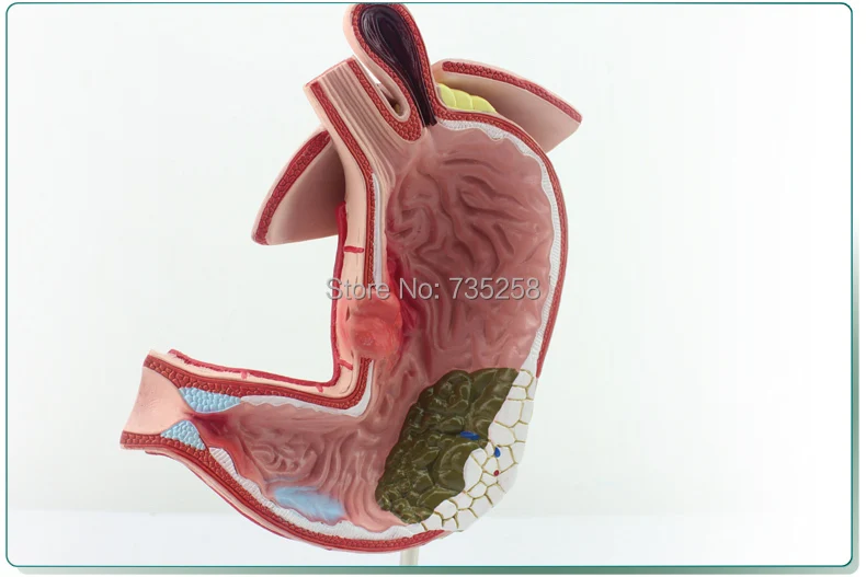 Gastric Lesions Presentation Model,Stomach Trouble Anatomical Model,Stomach Model