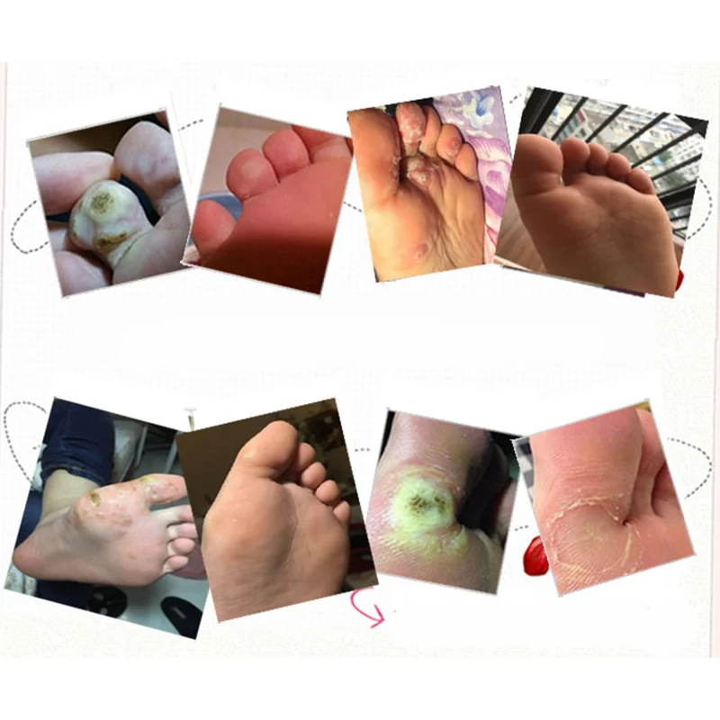 5 шт. пластырь для удаления бородавок с кукурузным крахмалом|Инструмент ухода за