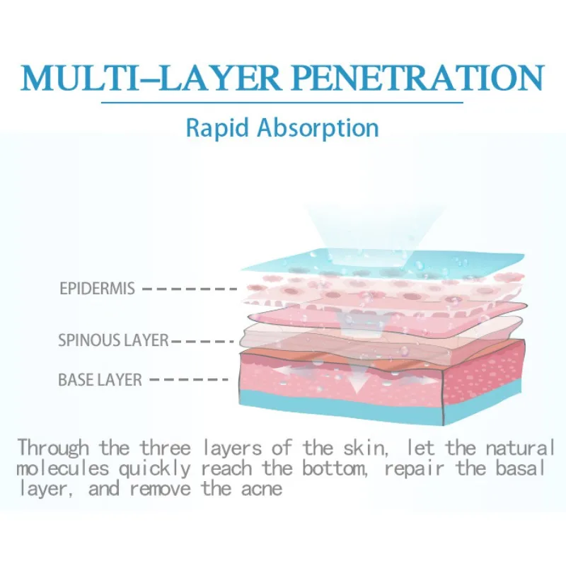 Крем для лечения акне удаление черных точек крем против контроль жирности