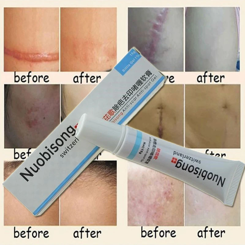 hot sales Nuobisong facial scar removal cremas Spots treatment whitening face cream stretch marks moisturizing New 2021 | Красота и