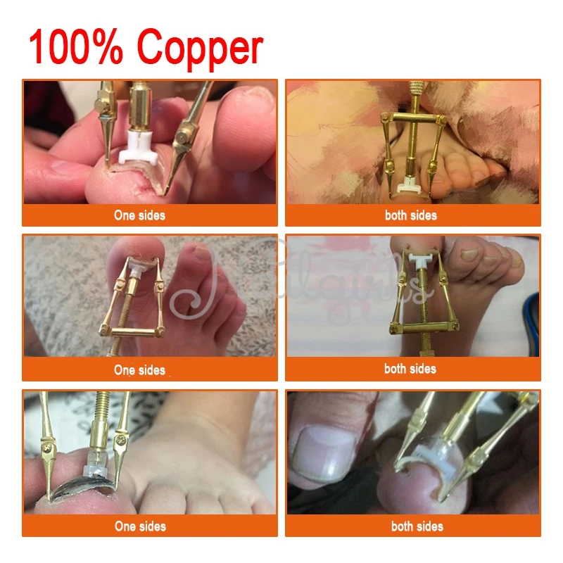 Средство для коррекции вросших ногтей 2 в 1 из 100% меди фиксирующий инструмент или