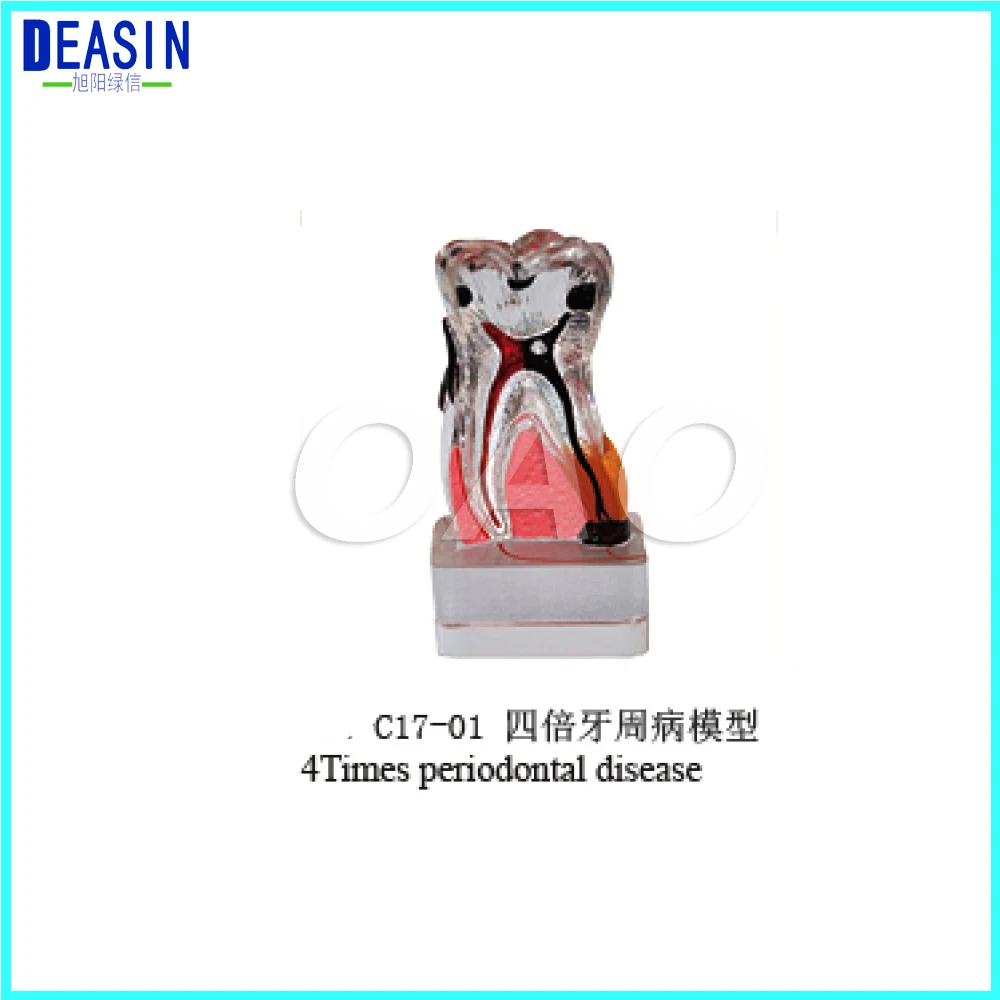 

Teeth model 4 times tooth model dental pathology teeth model, dental caries, calculus, pulp stones, Occlusal tooth wear