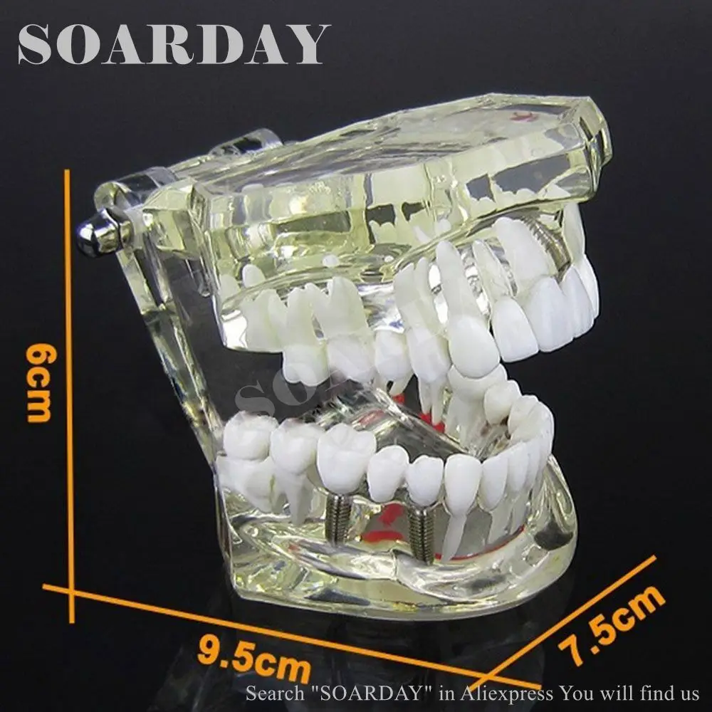 Модель импланта SOARDAY с реставрацией зубов стоматолога анатомическая модель