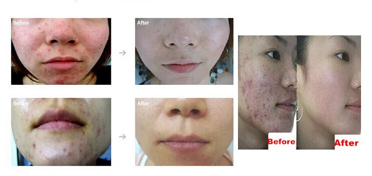 Крем унисекс против прыщей и 30 г|removal cream|pimples removal creamacne pimple remover cream |