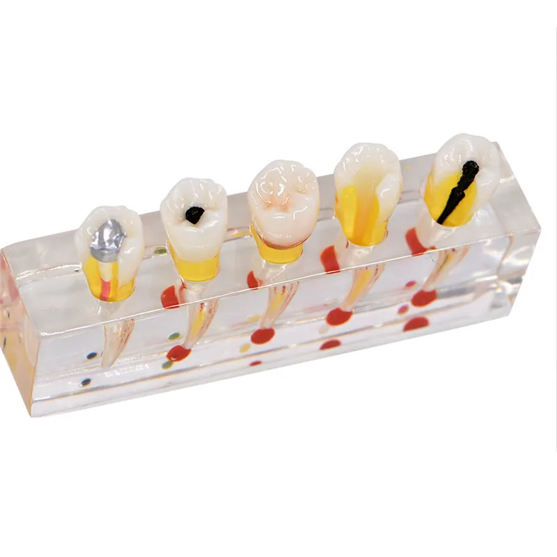 Dental Pulp Restoration Pathological Model with Detachable teeth Premolar caries crown pulp cavity filling | Красота и здоровье