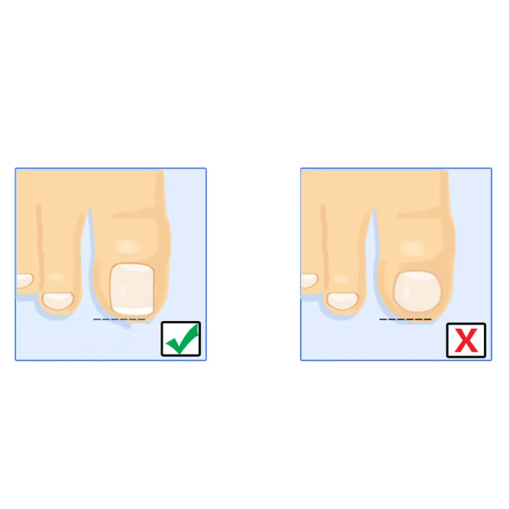 1Pc Ingrown Toe Nail Correction Sticker Patch Paronychia File Acronyx Wire Corrector Foot Care Tool | Красота и здоровье