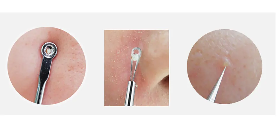 7/8 шт Blackhead Extractorde cravo черных точек прыщей жидкость для снятия иглы зажим Пинцет Набор черных точек комедонов черных точек полоски для Пинцет Комплект