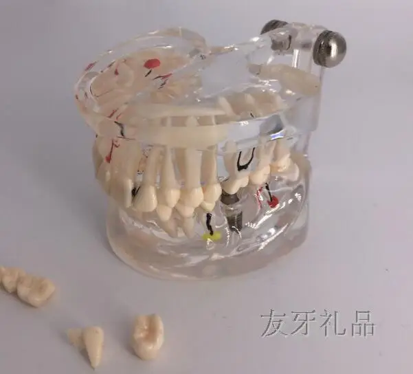 Медицинская наука Зуб модель взрослые прозрачные патологические