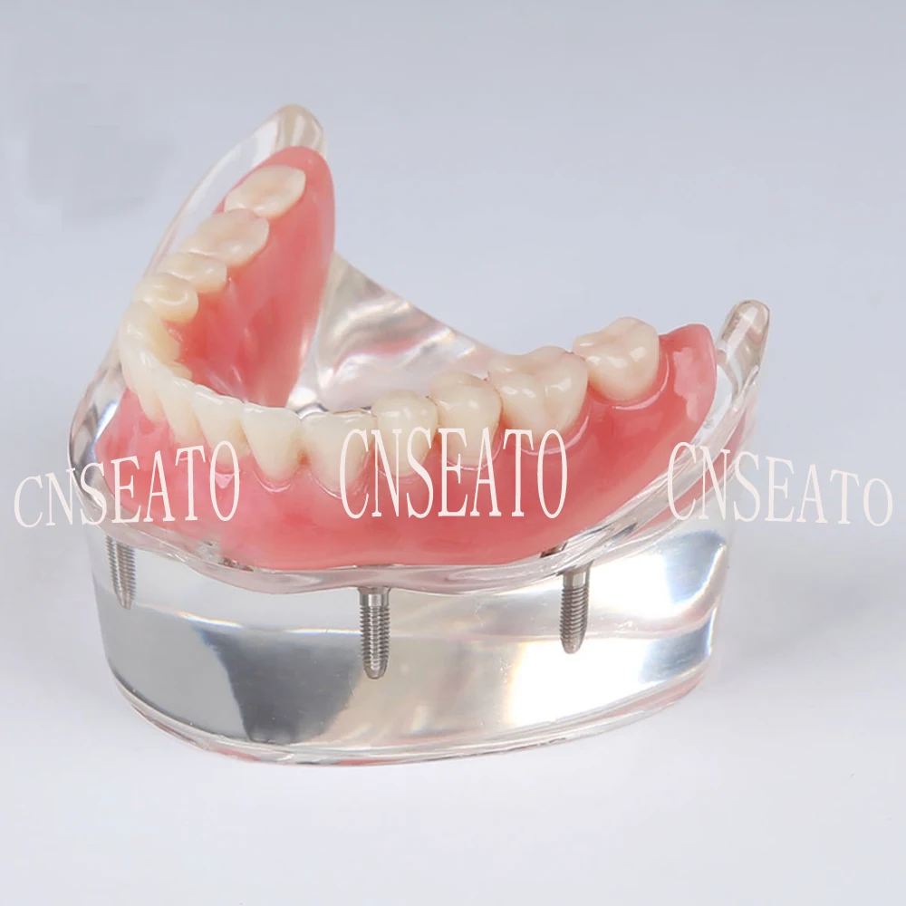 1 шт. стоматологический имплантат восстановление демонстрационная модель зубов M