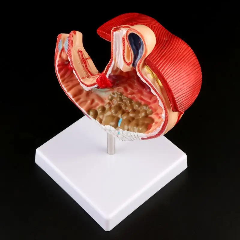 

Human Anatomical Anatomy Stomach Medical Model Gastric Pathology Gastritis Ulcer Medical Teaching Learning Tool