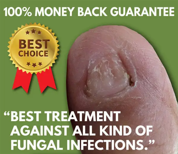 

Best TOENAIL & FINGERNAIL FUNGUS Treatment -- 100% MONEY BACK GUARANTEE