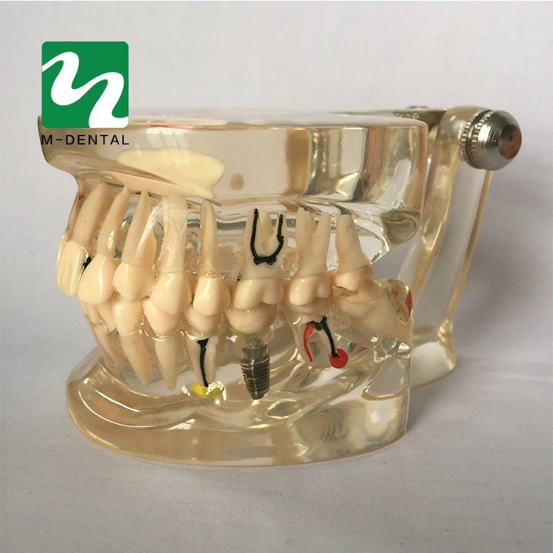 Модель зубов для обучения патологии и заболеваниям взрослых модель съемная